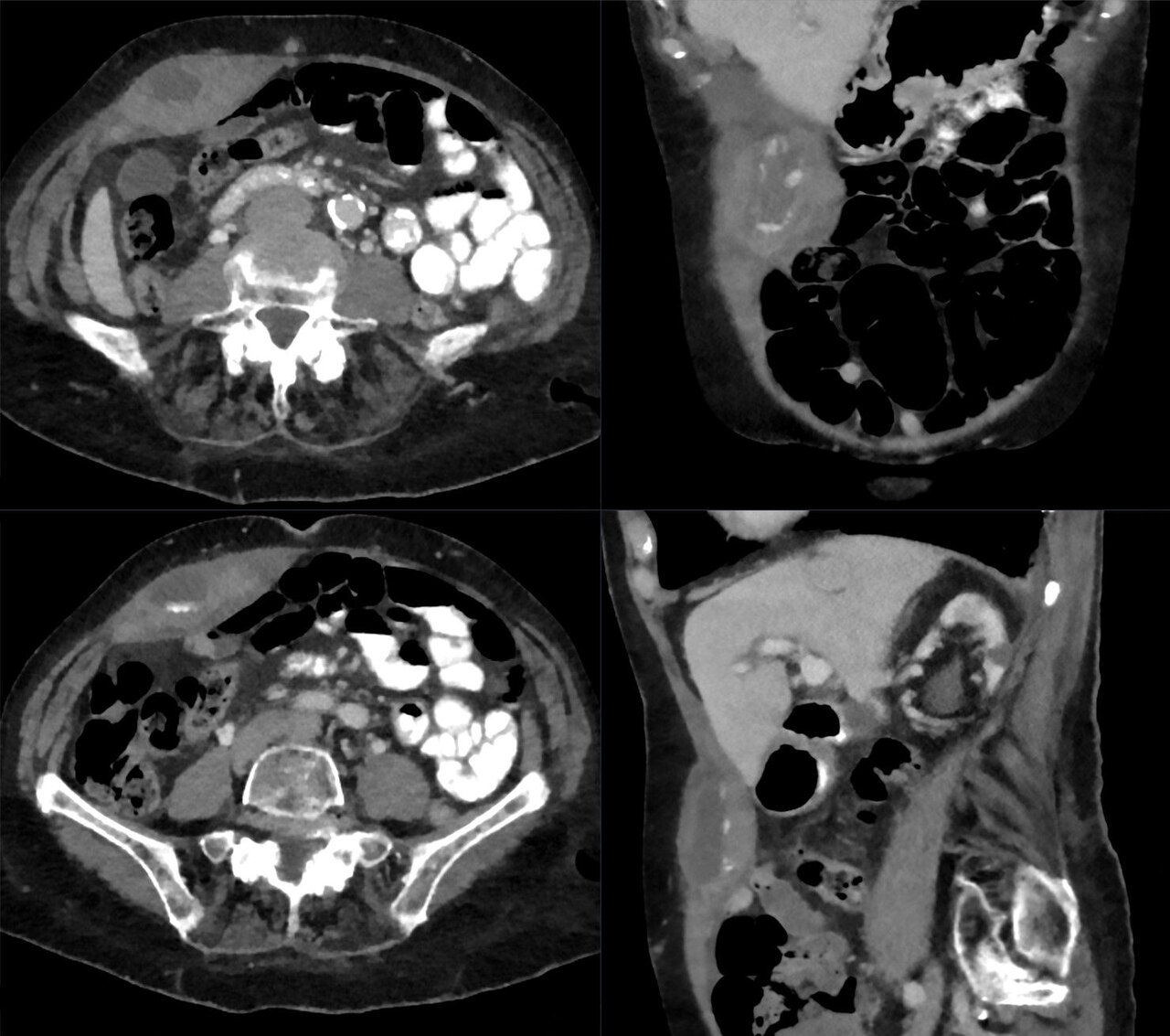 A contrast-enhanced abdominal CT scan shown in axial, coronal and sagittal views